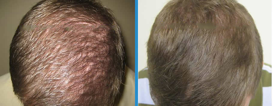 Hair-Regrowth-Treatment-Richmond-Surgical-Arts-Dr-Lynam