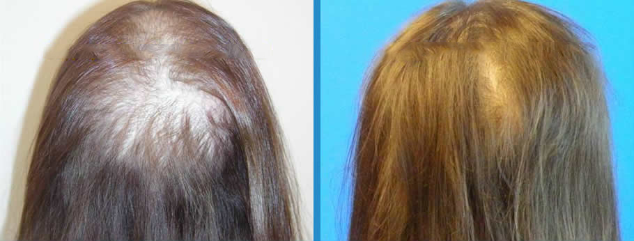 Hair-Regrowth-Treatment-Richmond-Surgical-Arts-Dr-Lynam-Case-Study2