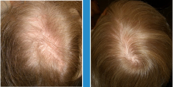 Hair-Regrowth-Treatment-Richmond-Surgical-Arts-Dr-Lynam-Case-Study3