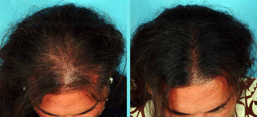 Hair-Regrowth-Treatment-Richmond-Surgical-Arts-Dr-Lynam-Case-Study4